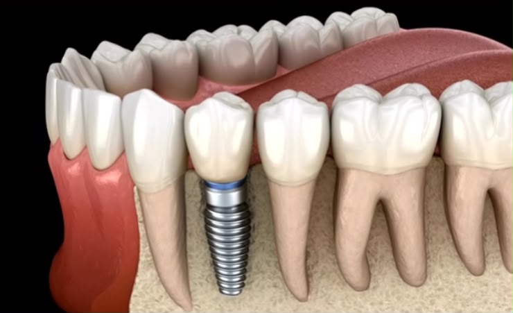 Anatomia de um implante dentário