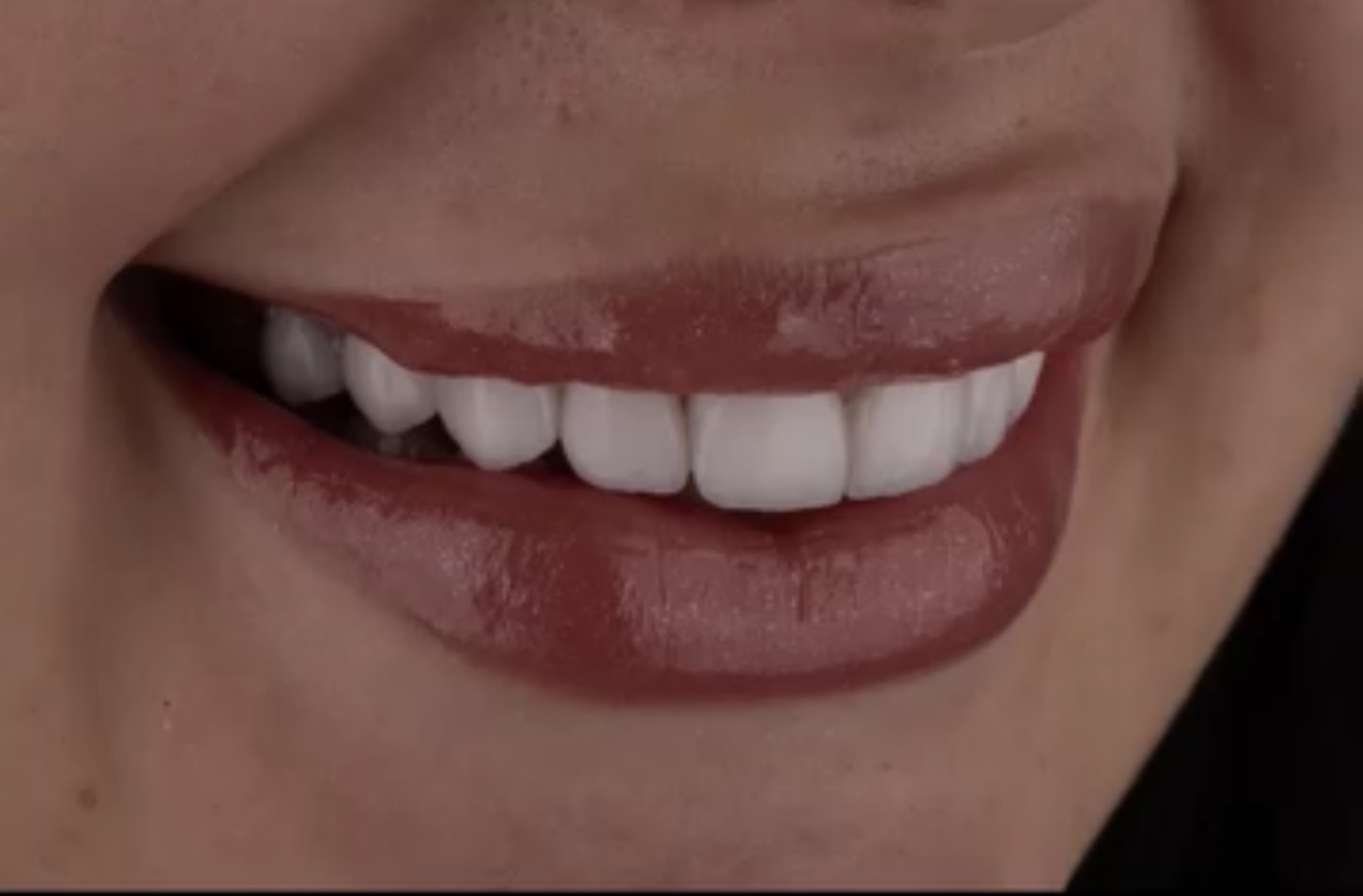 Resultado de sorriso 4