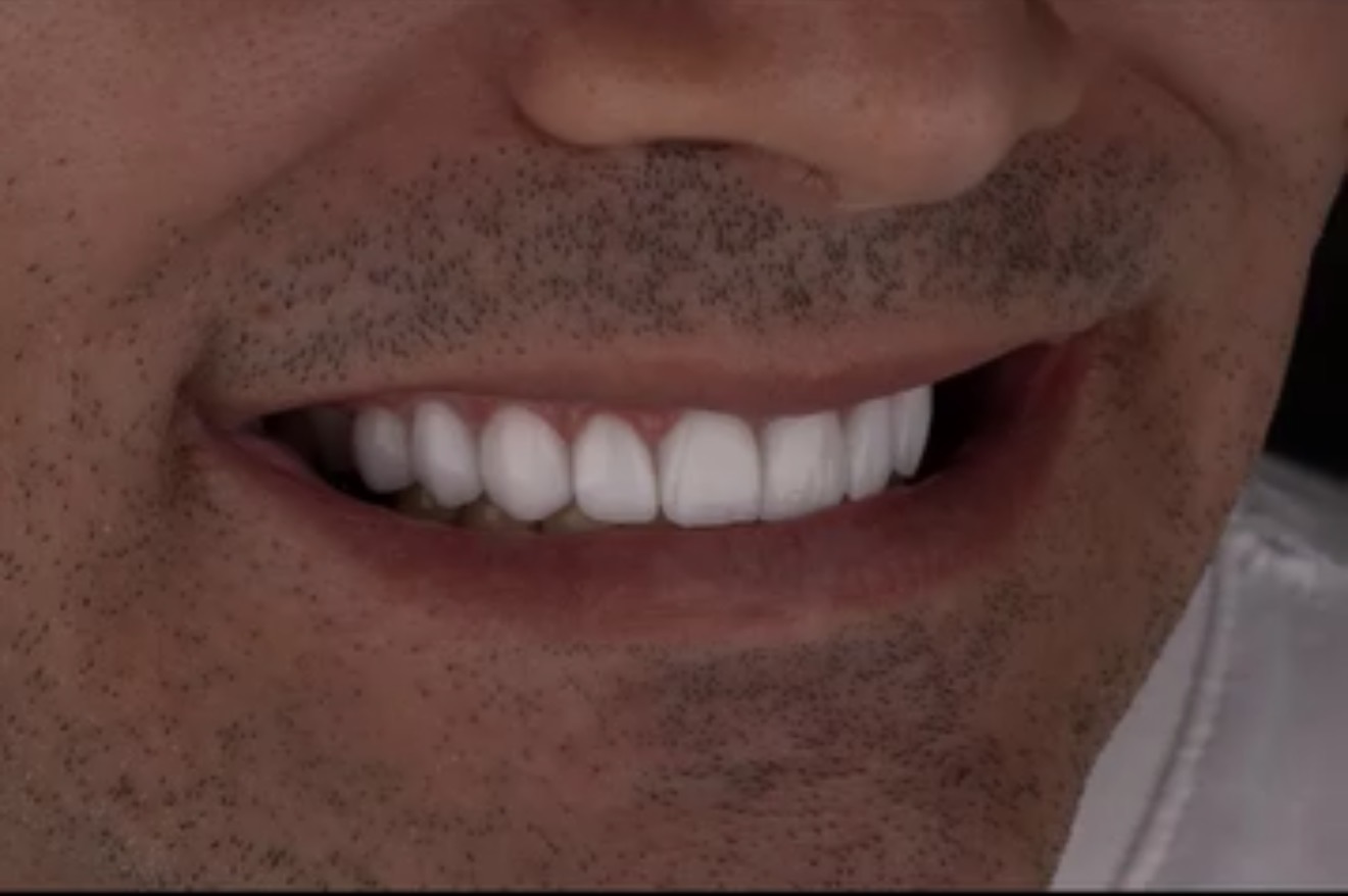 Resultado de sorriso 1