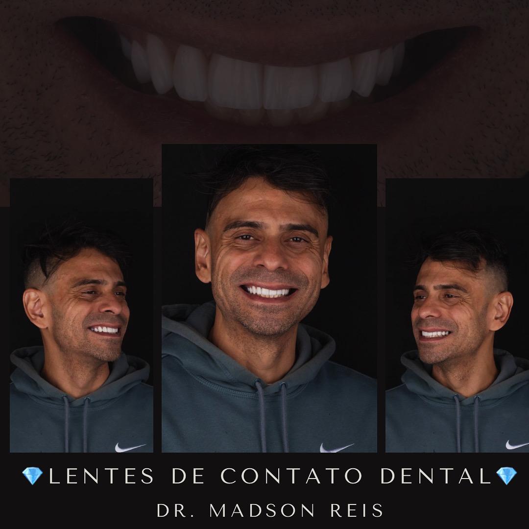 Lentes de contato dental — caso clínico do Dr. Madson Reis