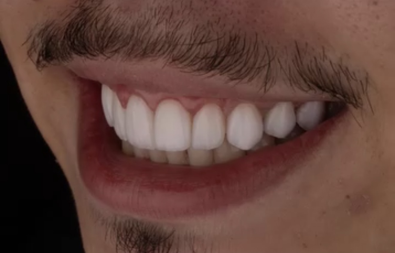 Resultado de sorriso 3